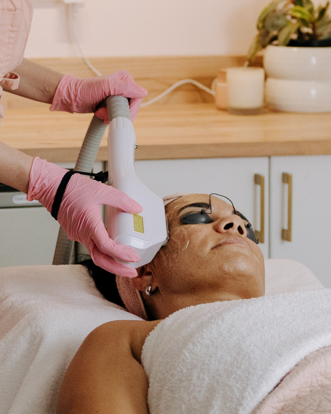 IPL Rejuvenation in Papamoa - Everything You Need to Know