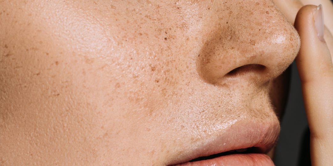 Microneedling | Collagen Induction Therapy (CIT)