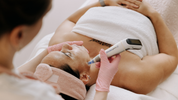 Microneedling collagen induction therapy treatment at Reveal Hair Skin Body Mount Maunganui and Papamoa Bay of Plenty New Zealand