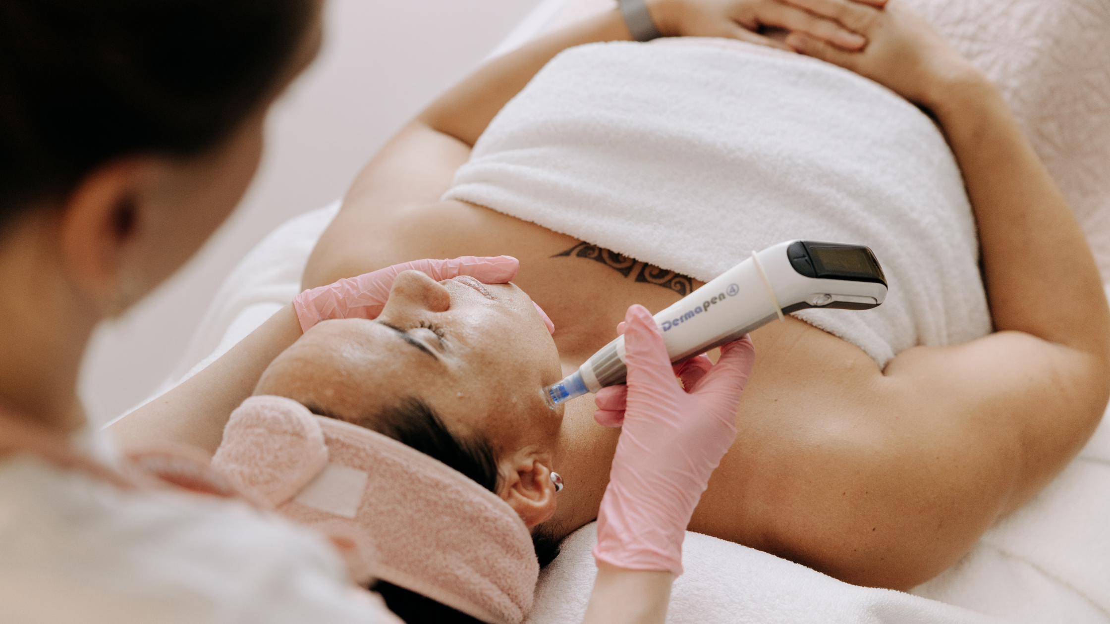 Microneedling collagen induction therapy treatment at Reveal Hair Skin Body Mount Maunganui and Papamoa Bay of Plenty New Zealand